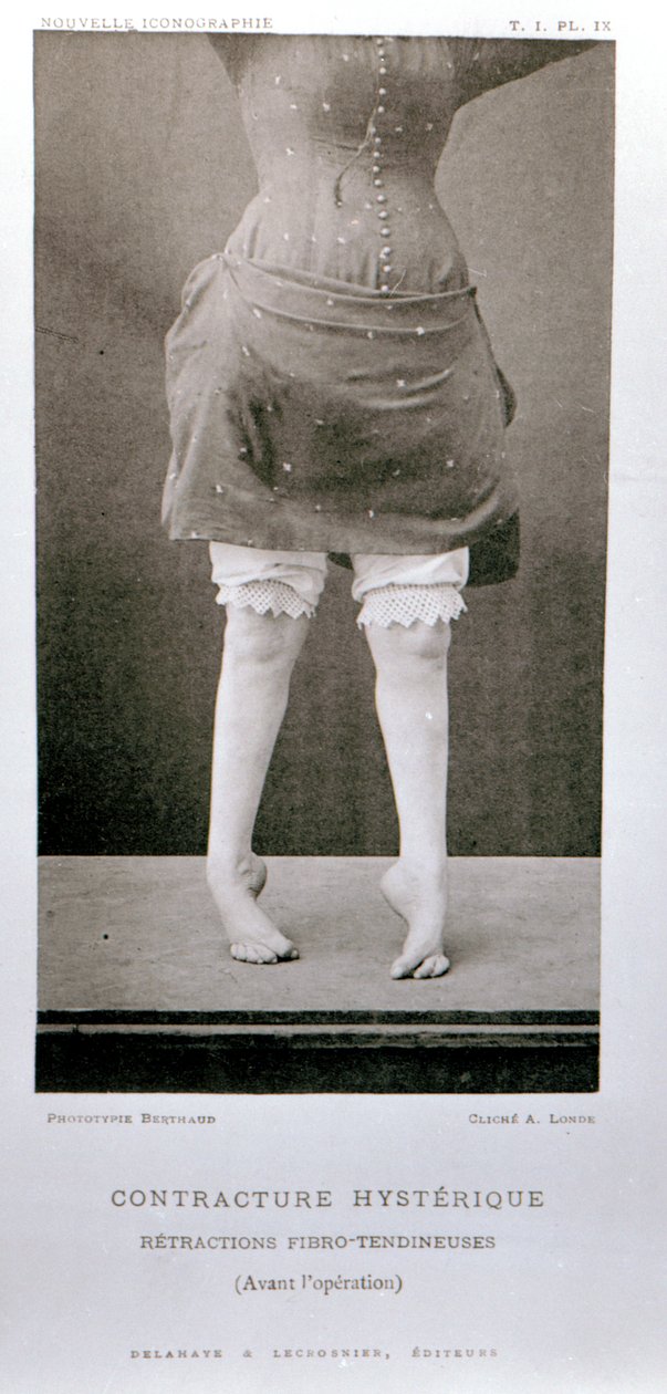 Mimowolny przykurcz, z „Nouvelle Iconographie de la Salpetriere” profesora Jeana Martina Charcota (1825-93) opublikowanej w Paryżu, 1889 autorstwa Albert Londe