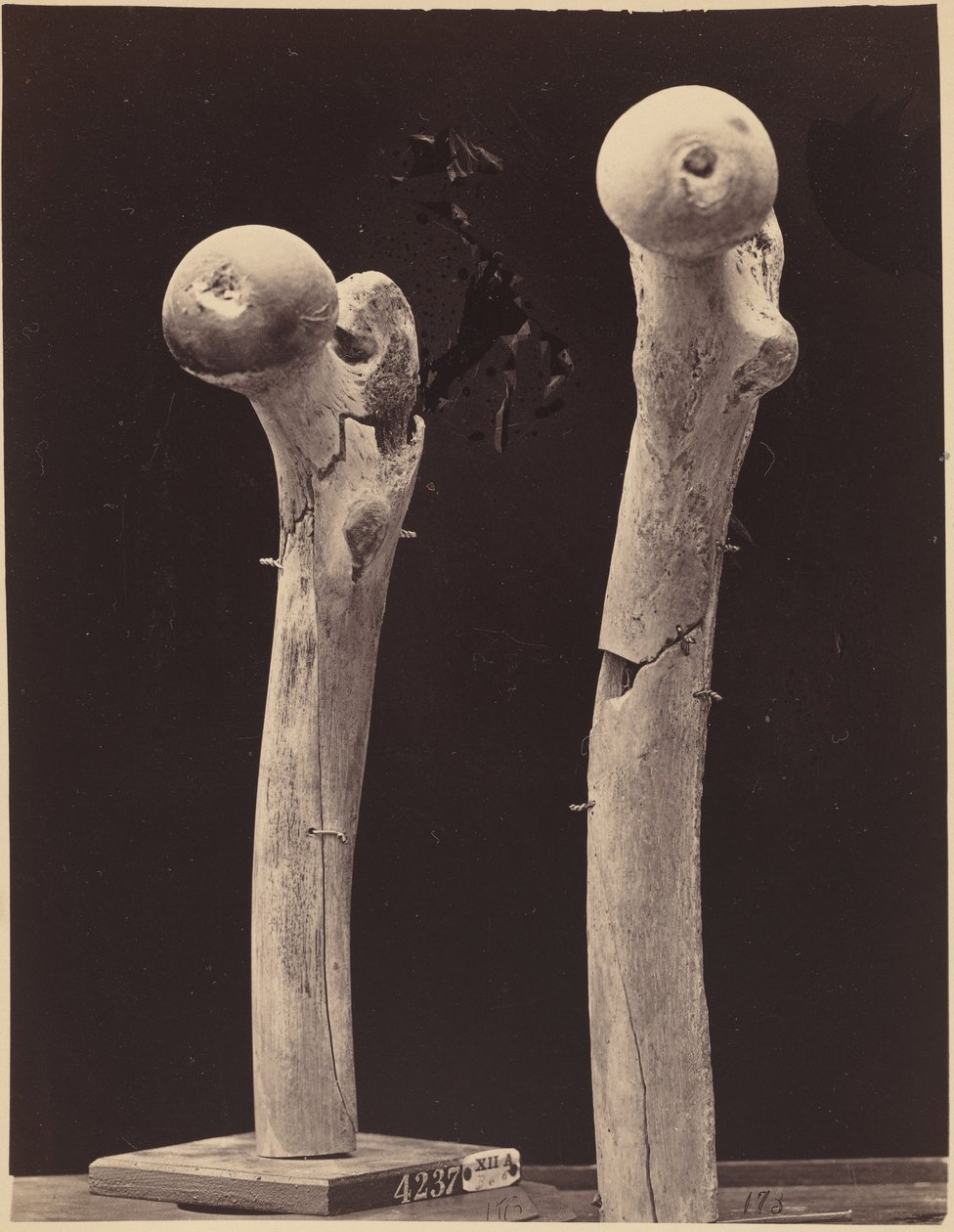 Okazy złamań kości udowej od postrzału, ok. 1867 (zdjęcie) autorstwa American Photographer