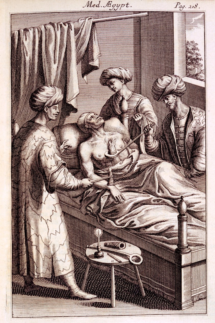 Ilustracja moxibustion z Medicina Aegyptorum autorstwa Prospero Alpinusa, 1745 autorstwa American School