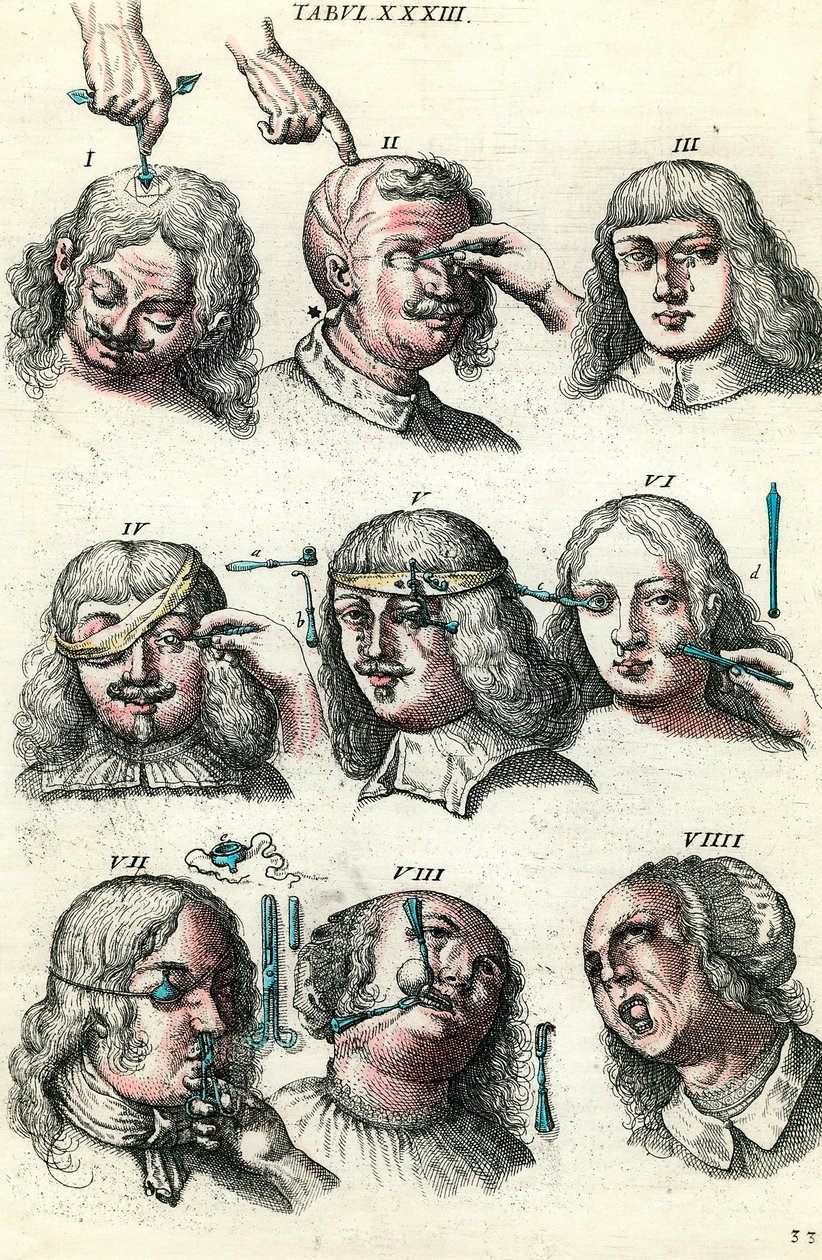 Chirurgia w XVIII wieku: Trepanacja i operacja oka i twarzy. Grawerowanie w „Institutions chirurgicale” Lorenza Heistera autorstwa Anonymous Anonymous
