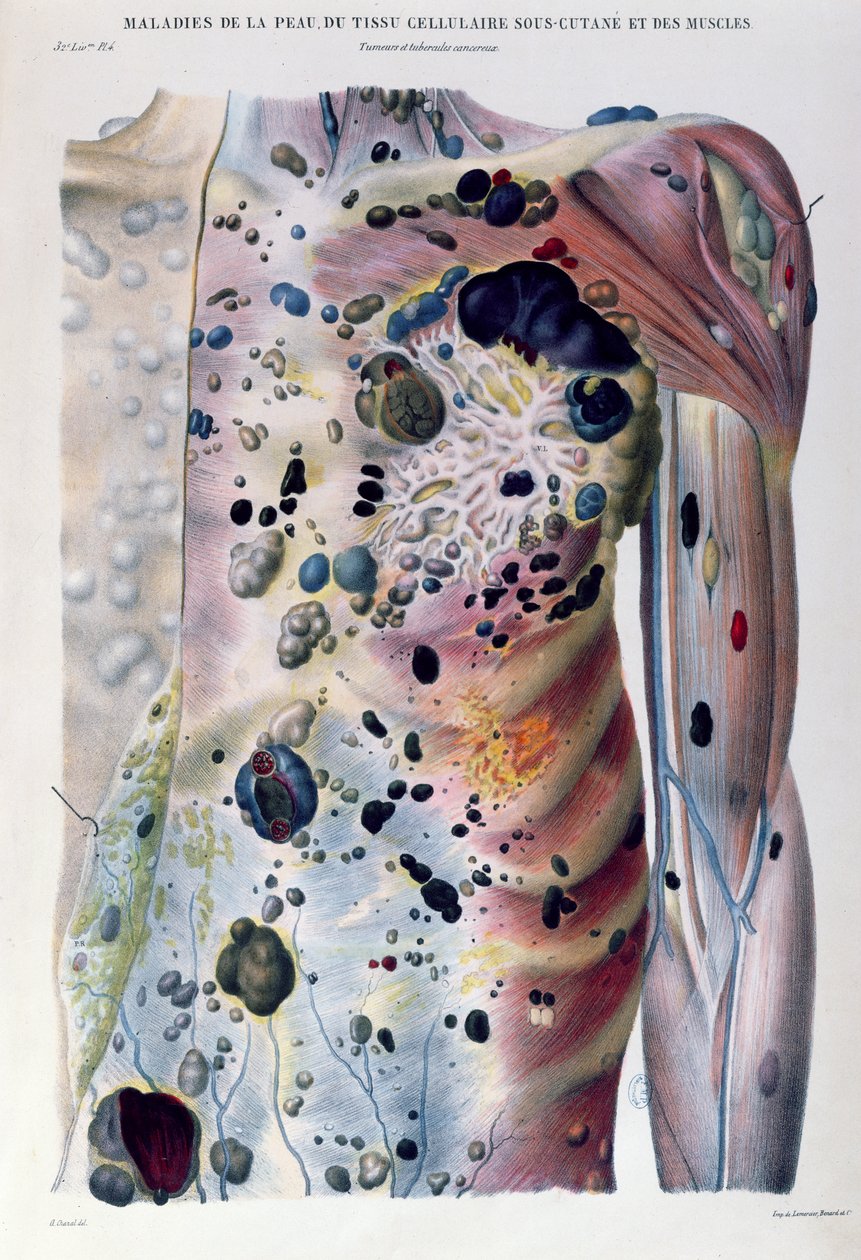 Guzy i guzki rakowe, z „Anatomie Pathologique du Corps Humain” Jeana Cruveilhiera (1791-1874) 1828-42 autorstwa Antoine Chazal