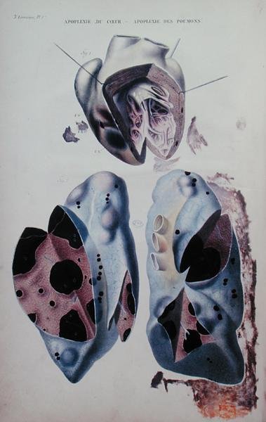 Apopleksja serca i płuc, płyta ilustracyjna z „Anatomie pathologique du corps humain” Jeana Cruveilhiera (1791-1874), wydanej w Paryżu autorstwa Antoine Chazal