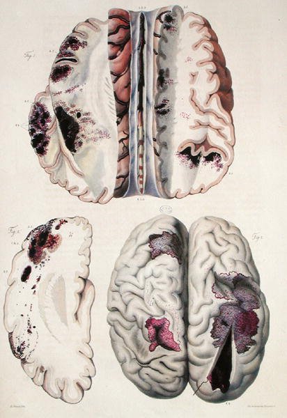 Udar kapilarny, z „Anatomie Pathologique du Corps Humain” Jeana Cruveilhiera (1791-1874) 1828-42 (kolorowa grawerunek) autorstwa Antoine Chazal