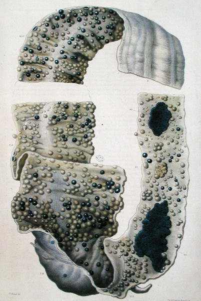 Choroby jelit, z „Anatomie Pathologique du Corps Humain” Jeana Cruveilhiera (1791-1874) 1828-42 (kolorowa grawerunek) autorstwa Antoine Chazal