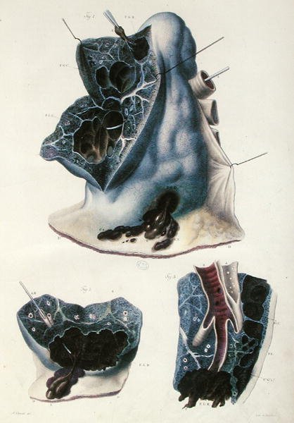 Choroby płuc, z „Anatomie Pathologique du Corps Humain” Jeana Cruveilhiera (1791-1874) 1828-42 (kolorowa grawerunek) autorstwa Antoine Chazal