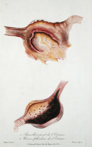 Zmiękczające i pęcherzykowe wrzody żołądka, z „Traite des Maladies des Enfans Nouveaux-Nes et a la Mamelle”, Charles-Michel Billard, grawerowane przez Stassel autorstwa Charles Michel (after) Billard