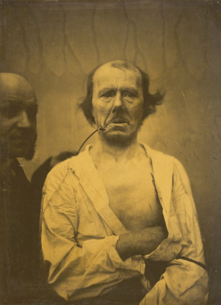 Zrelaksowany wyraz po lewej, Wstręt po prawej, 1854-1856, wydrukowany 1862. autorstwa Duchenne de Boulogne