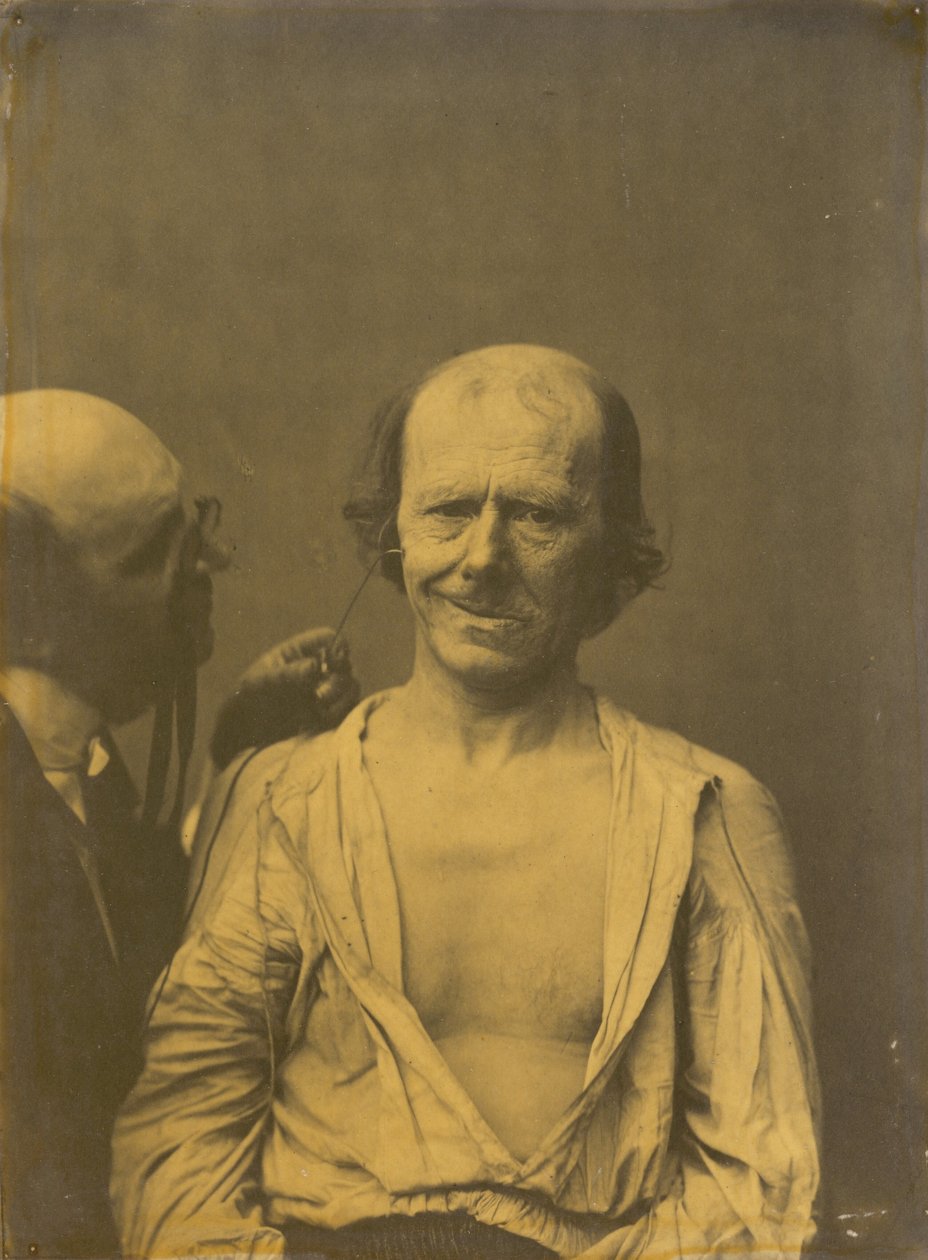 Zrelaksowana twarz po lewej, Fałszywa radość lub śmiech po prawej, 1854-1856, wydrukowane 1862. autorstwa Duchenne de Boulogne