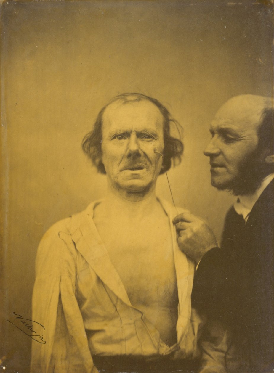 Płacz, łzy litości po lewej, Zrelaksowana twarz po prawej, 1854-1856, druk 1862. autorstwa Duchenne de Boulogne