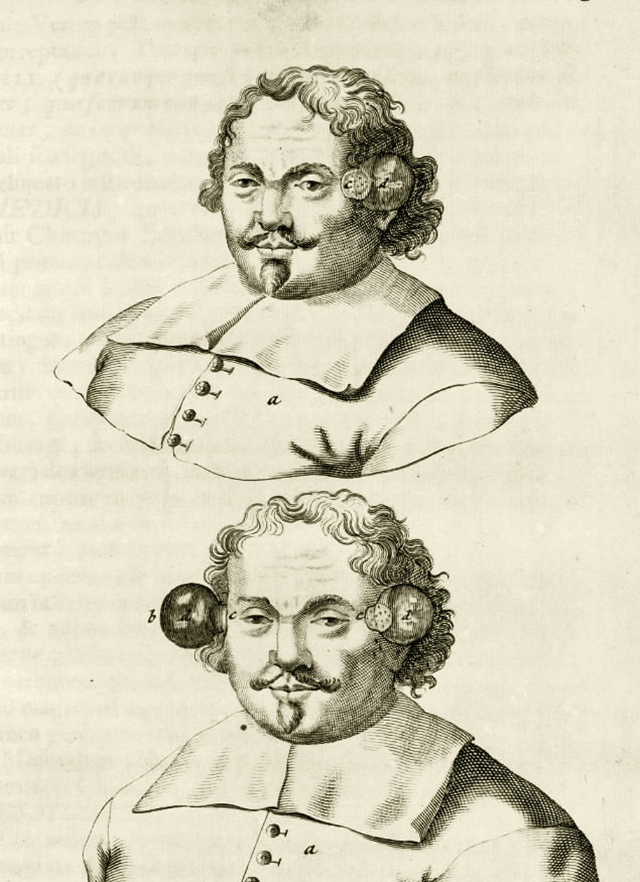 Przykład bańki, z The Practice of Medicine Frederika Dekkersa, 1694 autorstwa Dutch School
