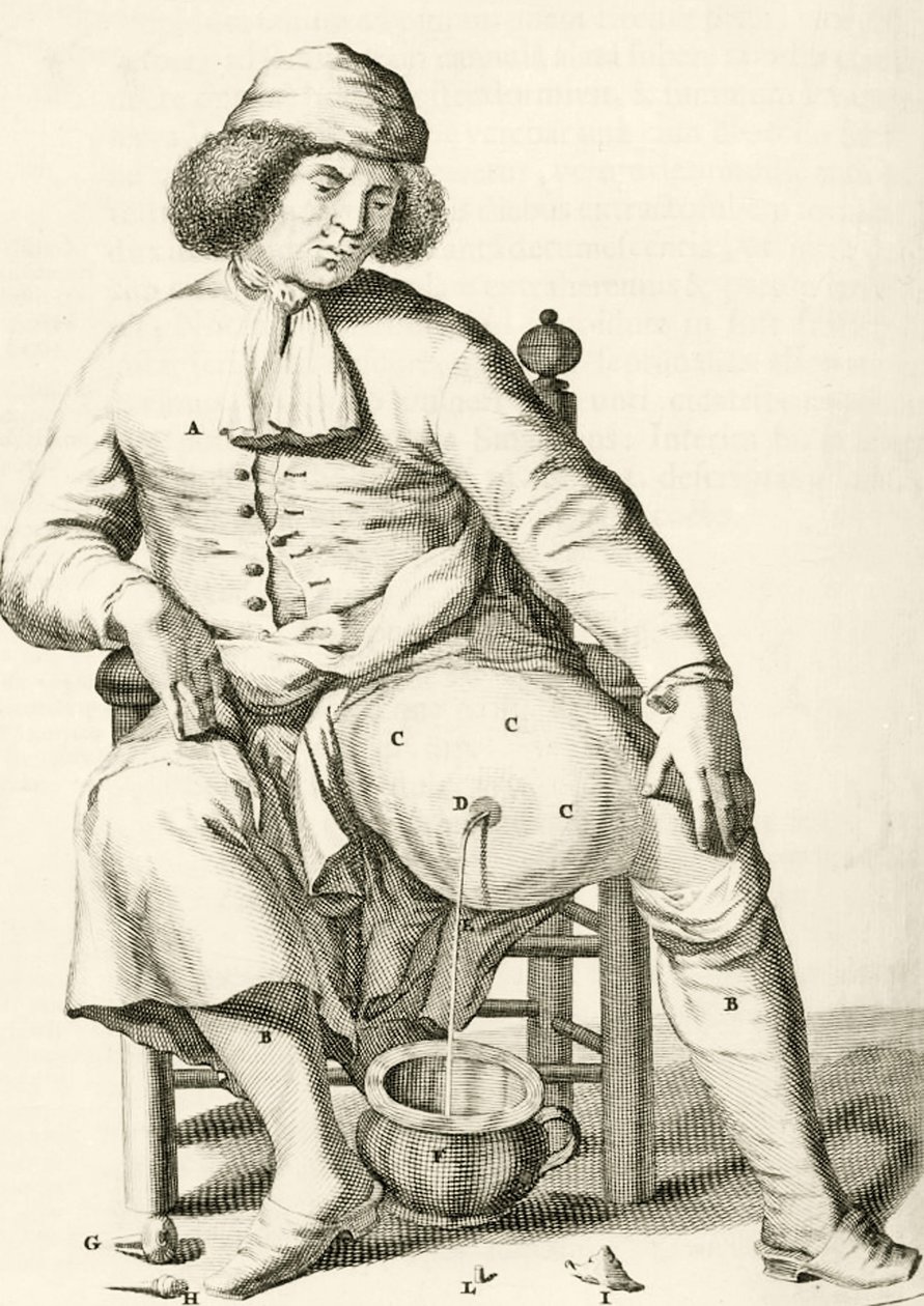 Odprowadzanie płynu z ropnia przez Frederika Dekkersa, 1694 autorstwa Dutch School