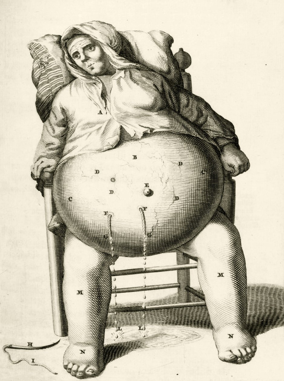 Odprowadzanie płynów z ropnia przez Frederika Dekkersa, 1694 autorstwa Dutch School