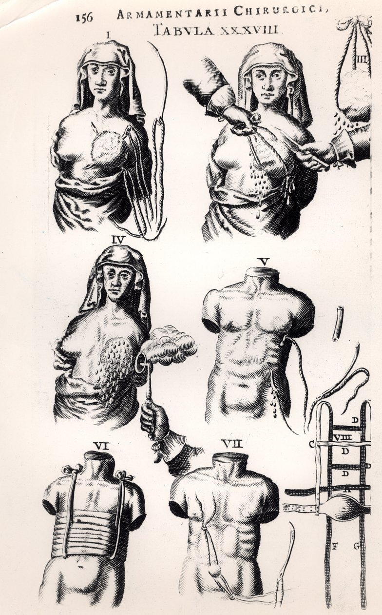 Operacja raka piersi, z Armamentarii Chirurgici Johannesa Schultesa (1595-1645) opublikowanej w Amsterdamie, 1672 autorstwa Dutch School