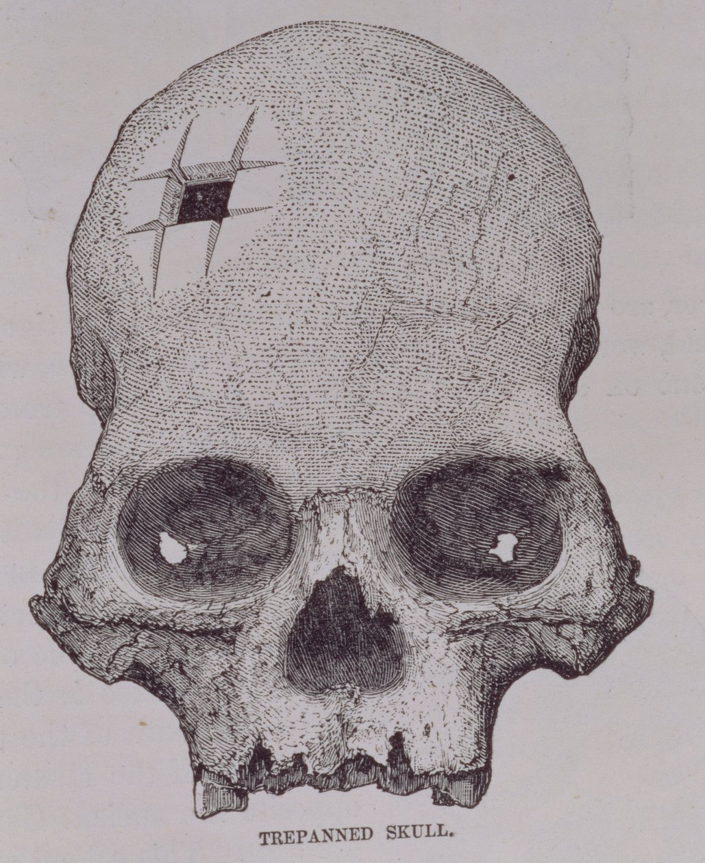 Czaszka trepanowana, z „Przypadków podróży i eksploracji w krainie Inków” E. George