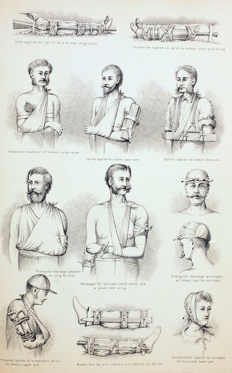 Tymczasowe leczenie złamań, c.1890 autorstwa English School