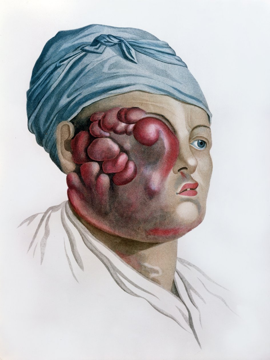 Skrofula rakowa, z Description des Maladies de la Peau autorstwa barona Jean Louis Alibert (1768-1837) Paryż, 1806 autorstwa French School
