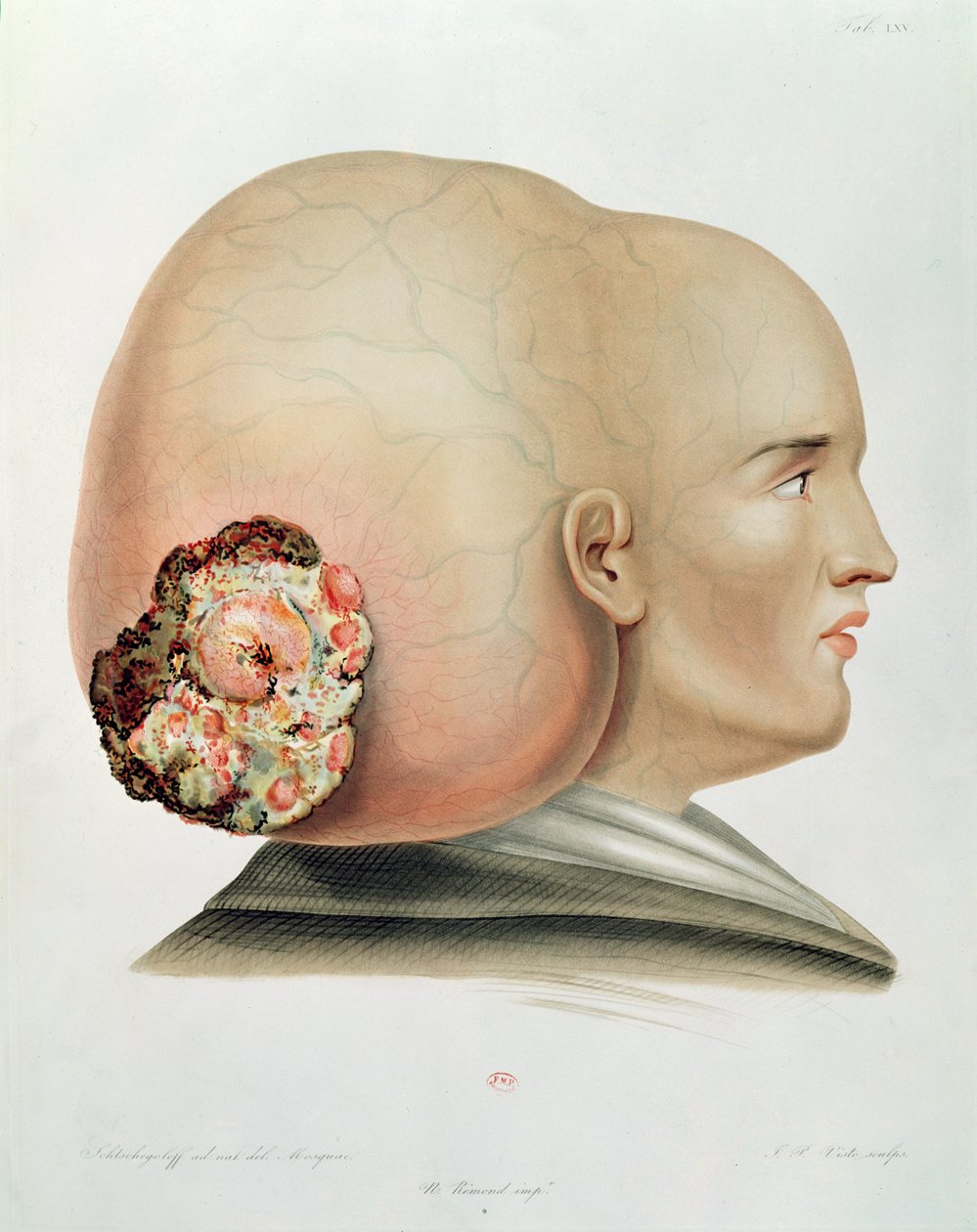 Grzyb opony twardej, z Selecta Praxis Medico-Chirurgica autorstwa Alexandra Auverta, Paryż, 1856 autorstwa French School