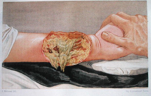 Zgorzel szpitalna, z „Traite de Chirurgie de Guerre”, autorstwa Edmunda Delorme
