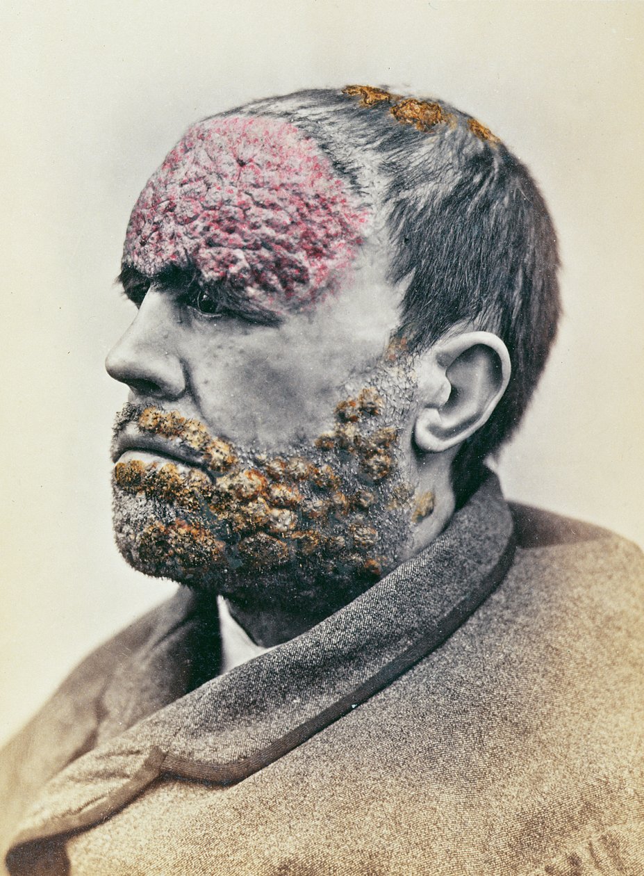 Mężczyzna chory na kiłę, z fotografii wykonanej dla Clinique Photographique de lHopital Saint-Louis, 1868 autorstwa French School