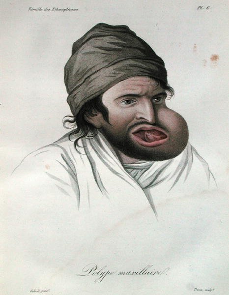 Polip szczękowy, z książki barona Jean Louis Alibert (1768-1837) 1817 (rycina kolorowana) autorstwa French School