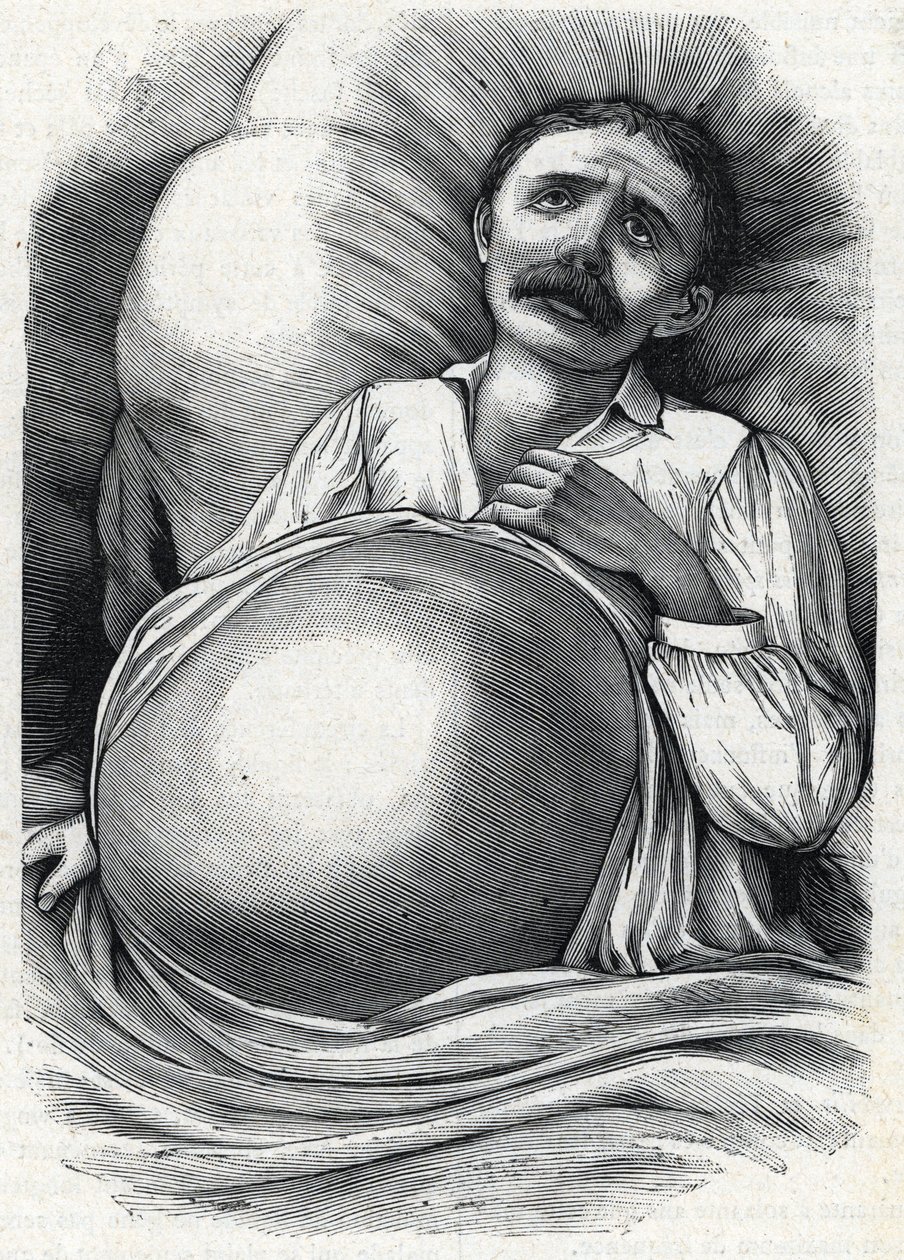 Pacjent z zaawansowaną marskością wątroby (grawer) 1888 autorstwa French School