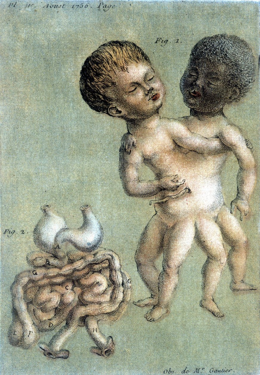 Talerz z lekarstwami przedstawiający braci syjamskich: biały i czarny. ilustracja Toussainta (1756) w „Okresowych obserwacjach fizyki, historii naturalnej i sztuce”. autorstwa French School