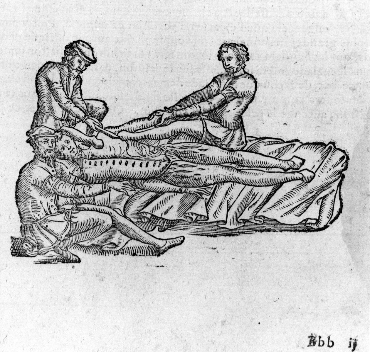 Redukcja zwichnięcia, w „Traktacie medycznym Ambroise Paré”, około 1560 r. autorstwa French School