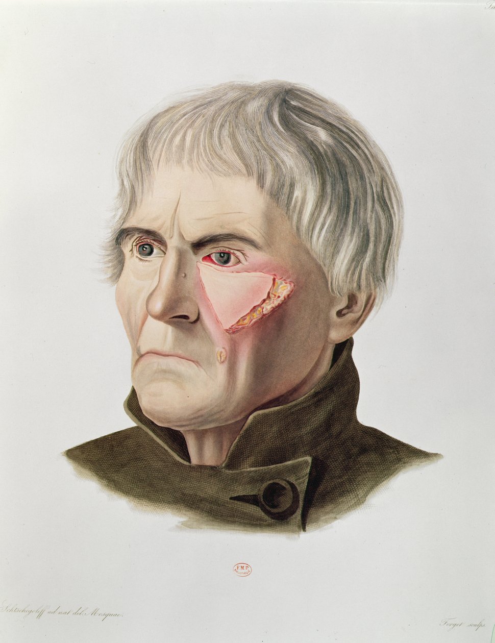 Operacja przeszczepu skóry, z Selecta Praxis Medico-Chirurgica, Alexander Auvert, Paryż, 1856 autorstwa French School