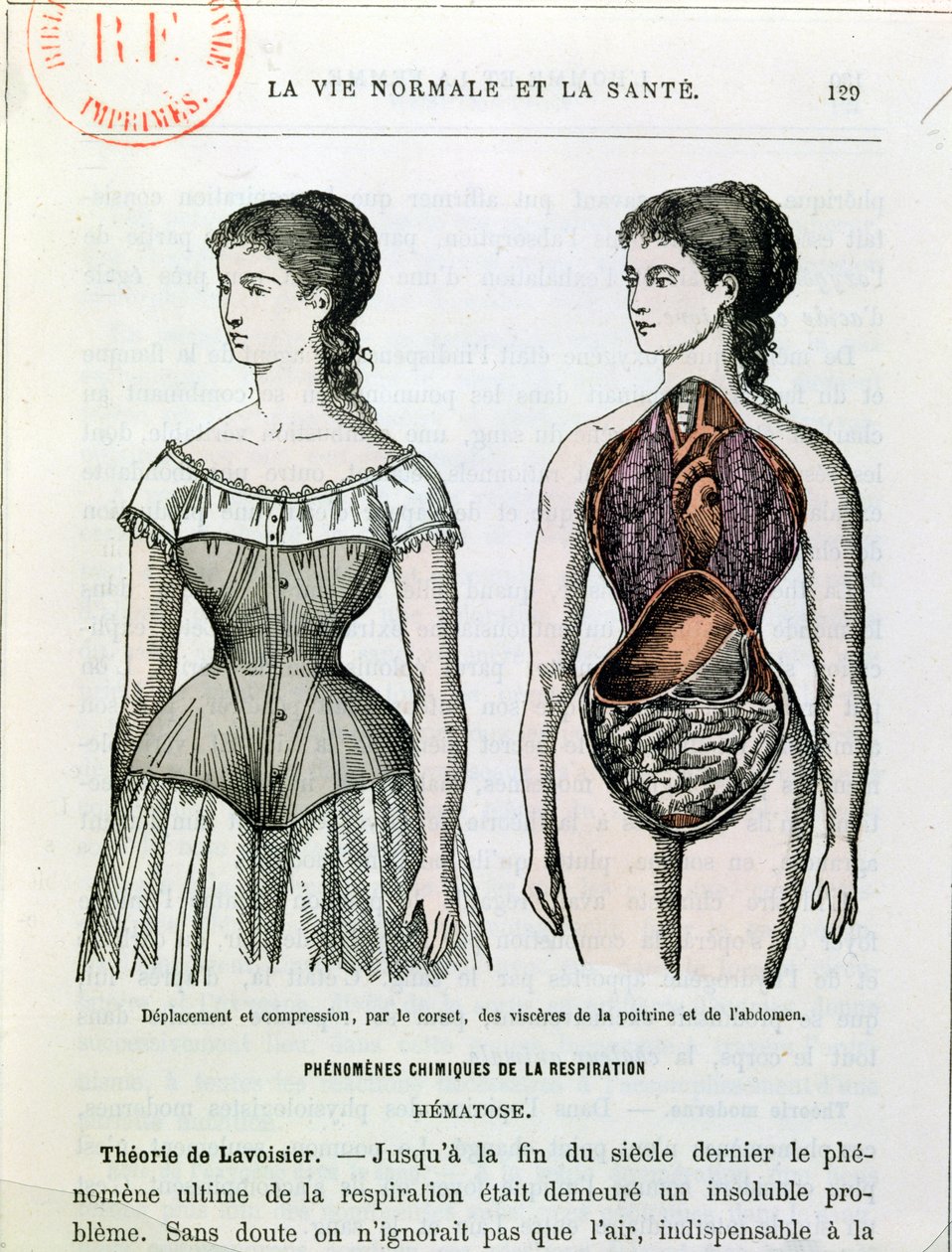 Szkodliwe skutki gorsetu, ilustracja z La Vie Normale et la Sante autorstwa dr Julesa Rengade (ur. 1841 r., ok. 1880 r.) autorstwa French School