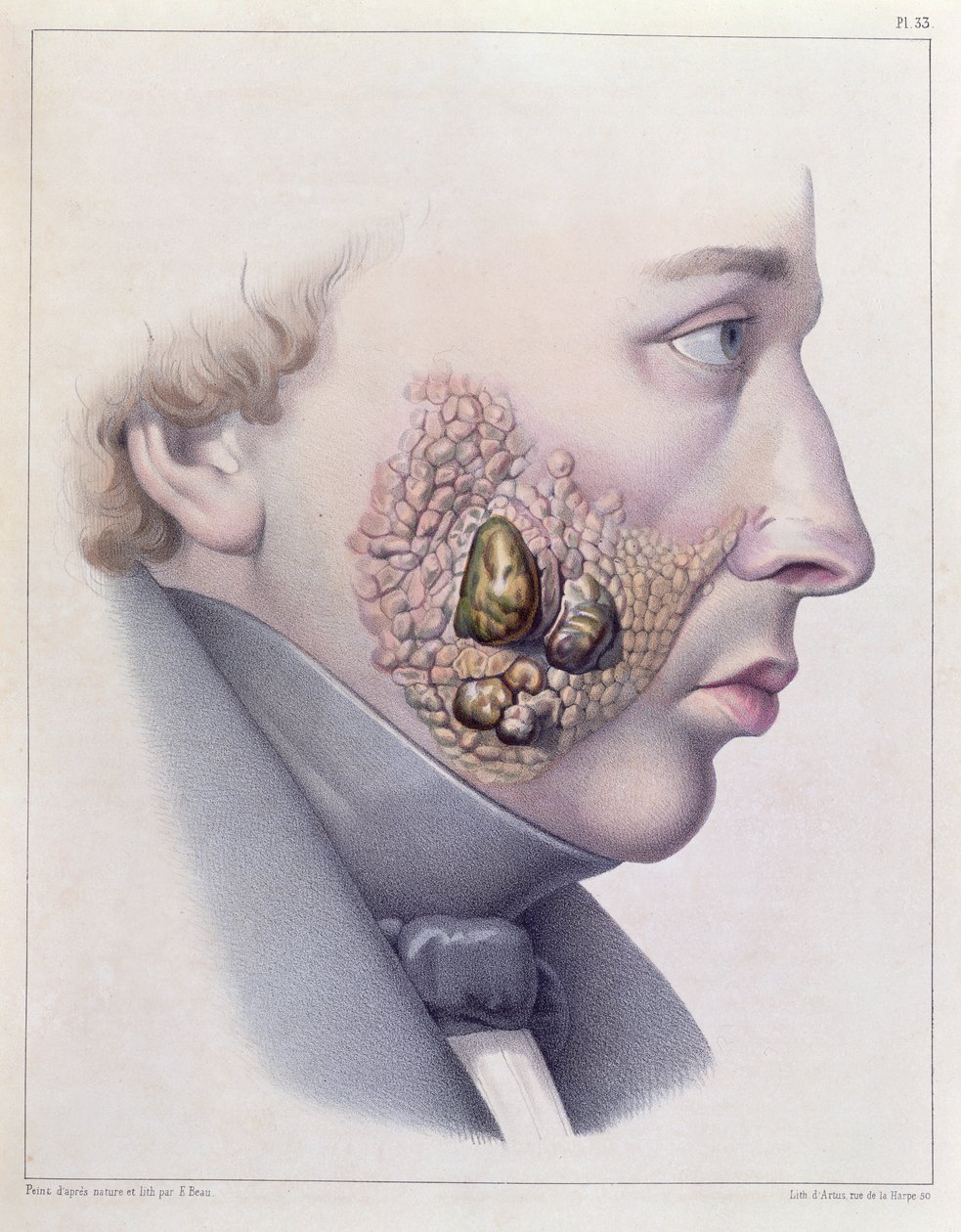 Twarzowe objawy choroby wenerycznej, z Traite Complet des Maladies Veneriennes autorstwa Philippe