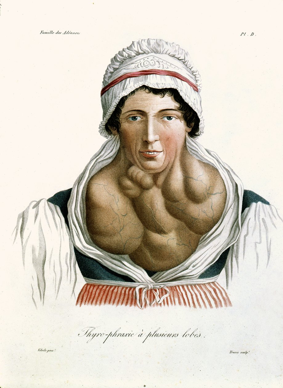 Choroba tarczycy, z książki barona Jean Louis Alibert (1768-1837) 1817 autorstwa French School