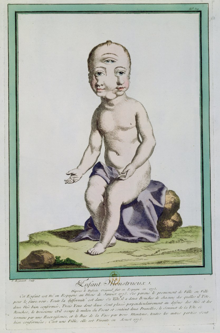 Dziecko ze zdeformowaną głową, z „Les Ecarts de la Nature”, Paryż, 1775 autorstwa Genevieve Regnault de Nangis