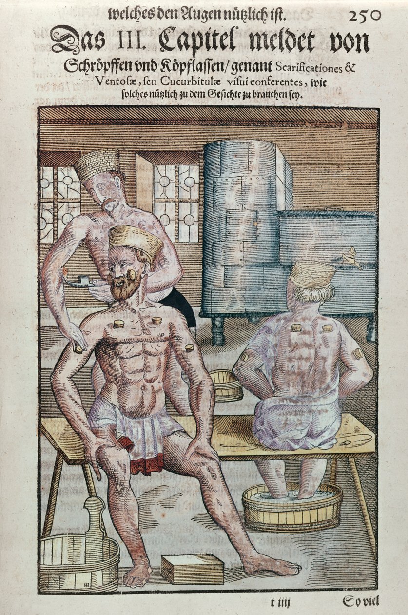 Cupping z Ophthalmodouleia Georga Bartischa (1535-1636) wydany w Dreźnie w 1583 r. (kolorowy drzeworyt) autorstwa German School