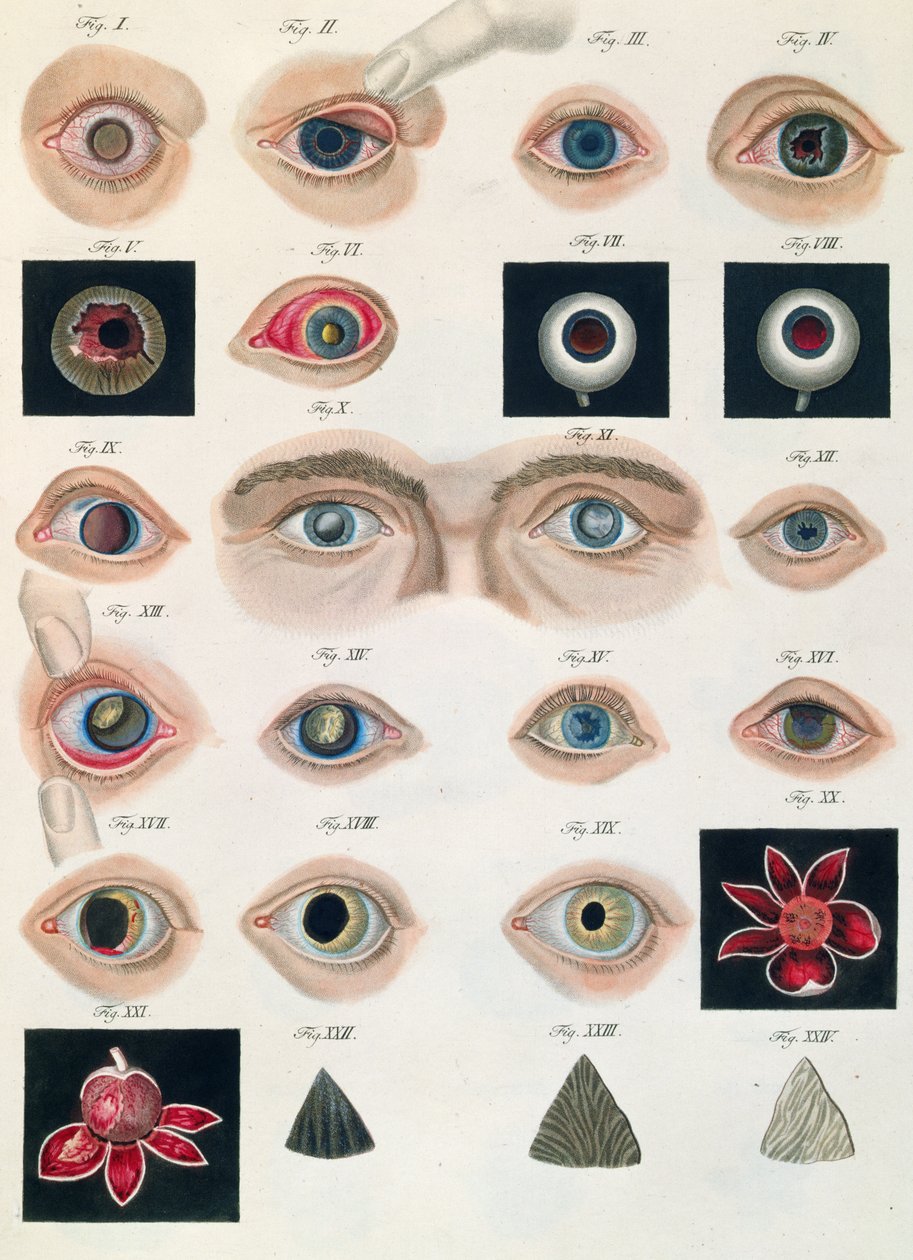 Opis wrodzonych anomalii oka, z Obrazów klinicznych chorób i wad wzroku ludzkiego oka, Friedrich August von Ammon (1799-1861) 1838 autorstwa German School