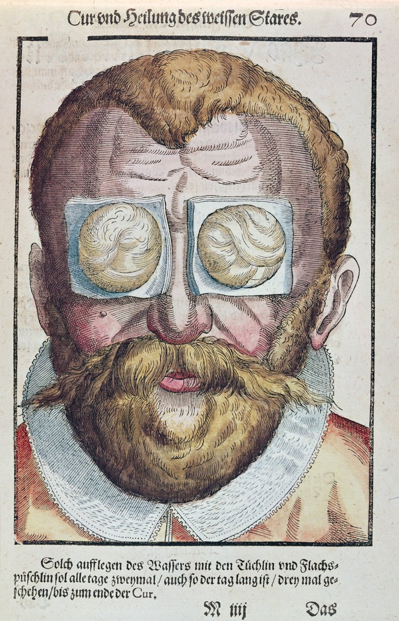 Leczenie choroby oka, z Ophthalmodouleia Georga Bartischa (1535-1636) wydanej w Dreźnie w 1583 r. (kolorowy drzeworyt) autorstwa German School