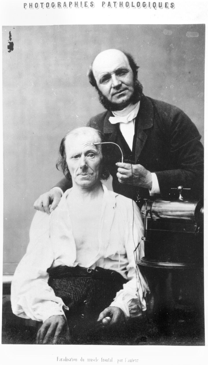Faradyzacja mięśnia czołowego, z „Album de photographies pathologiques” Duchenne de Boulogne, opublikowany 1862, Paryż autorstwa Guillaume Benjamin Armand Duchenne de Boulogne