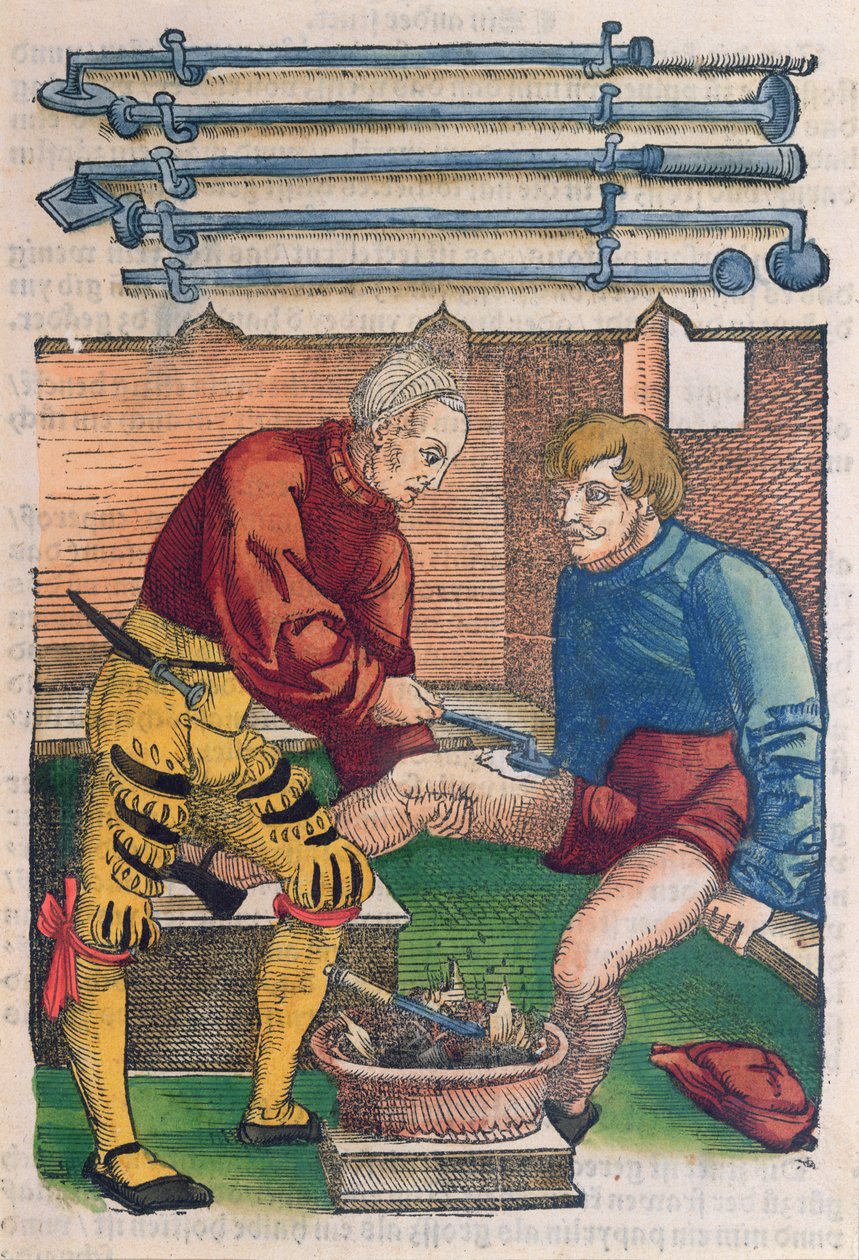 Kauteryzacja, ilustracja z „Feldtbuch der Wundartzney” Hansa von Gersdorffa, ok. 1540 (kolorowy drzeworyt) autorstwa Hans or Johannes Ulrich Wechtlin