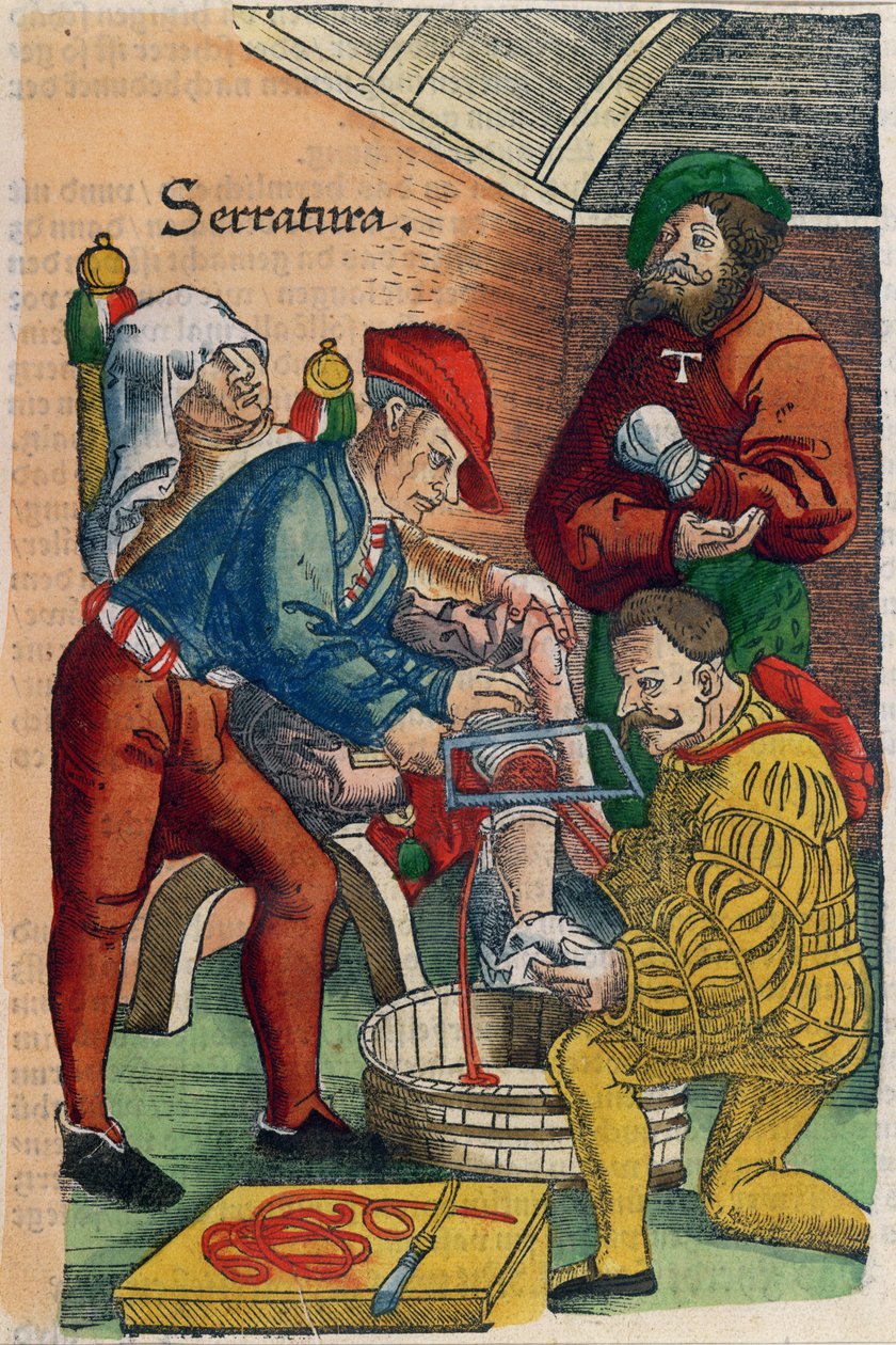 Amputacja, ilustracja z „Feldtbuch der Wundartzney” Hansa von Gersdorffa, ok. 1540 (kolorowy drzeworyt) autorstwa Hans or Johannes Ulrich Wechtlin