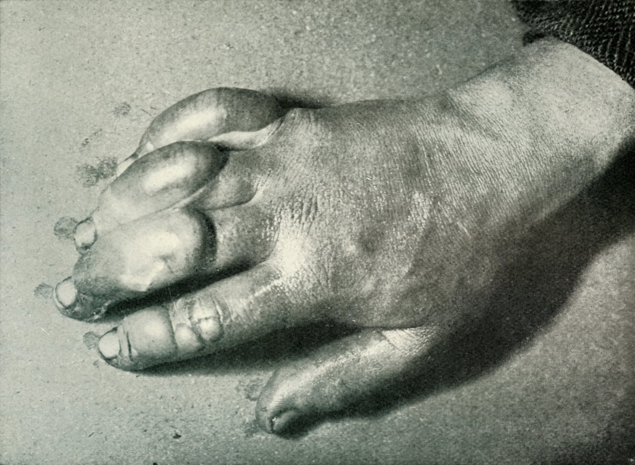 Dr Atkinsons Frost-Bitten Hand, 5 lipca 1911, 1913 autorstwa Herbert Ponting