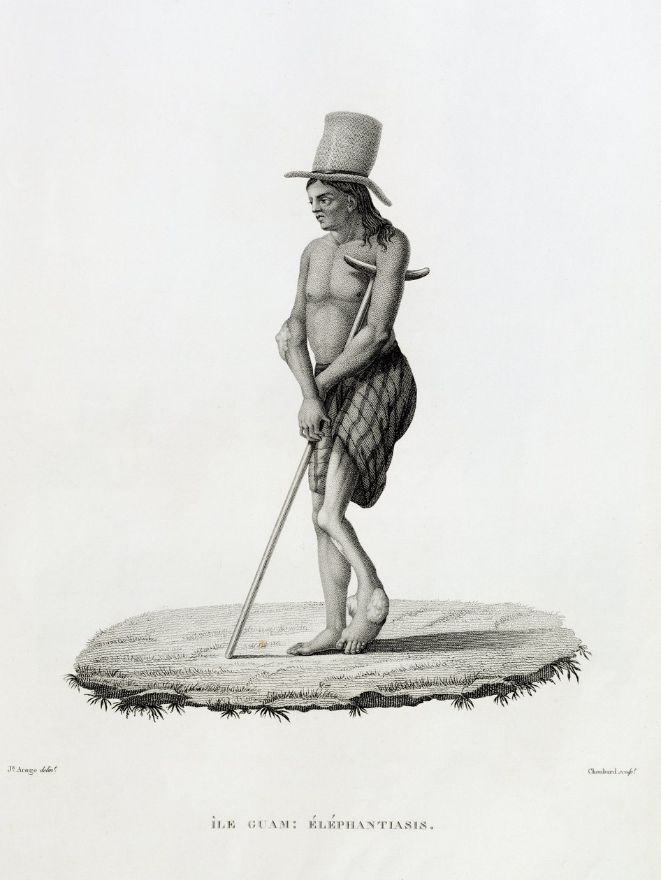 Guam: A Man with Elephantiasis, z „Voyage Autour du Monde sur les Corvettes de L