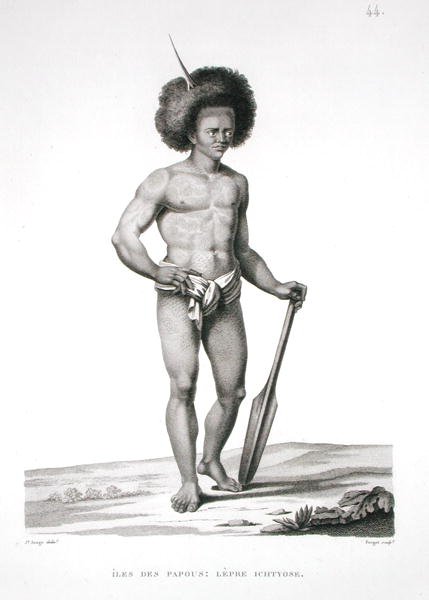 Papua: Ofiara trądu, z „Voyage Autour du Monde (1817-20)”, Louis Claude Desaulses de Freycinet (1779-1842) ryty przez Forget, opublikowana 1822-24 (lito) autorstwa Jacques Etienne Victor (after) Arago