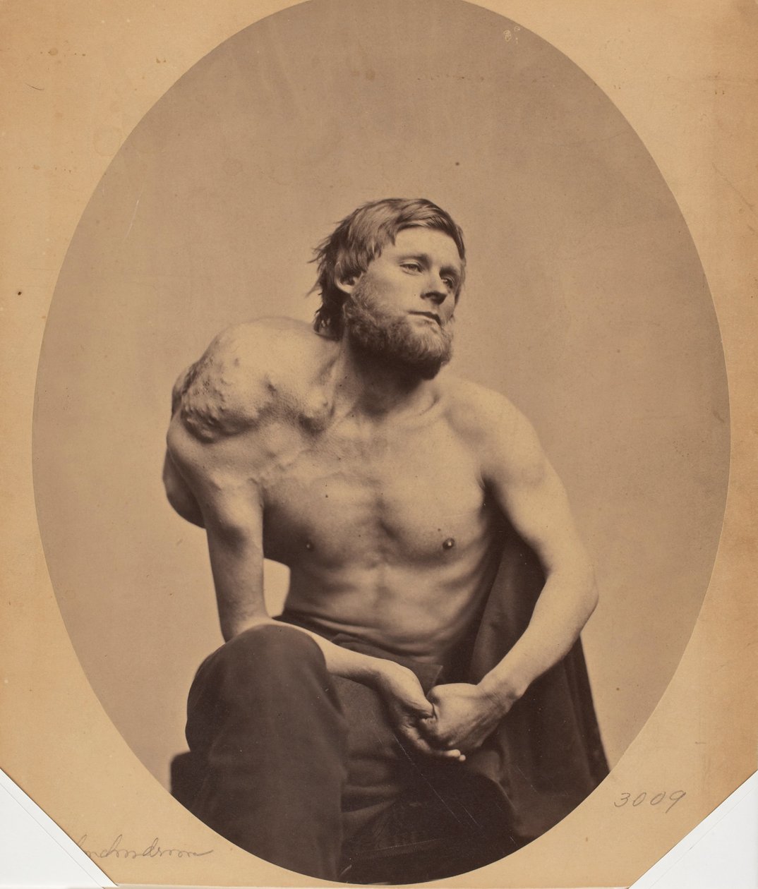 Enchondroma łopatki autorstwa James Wallace Black