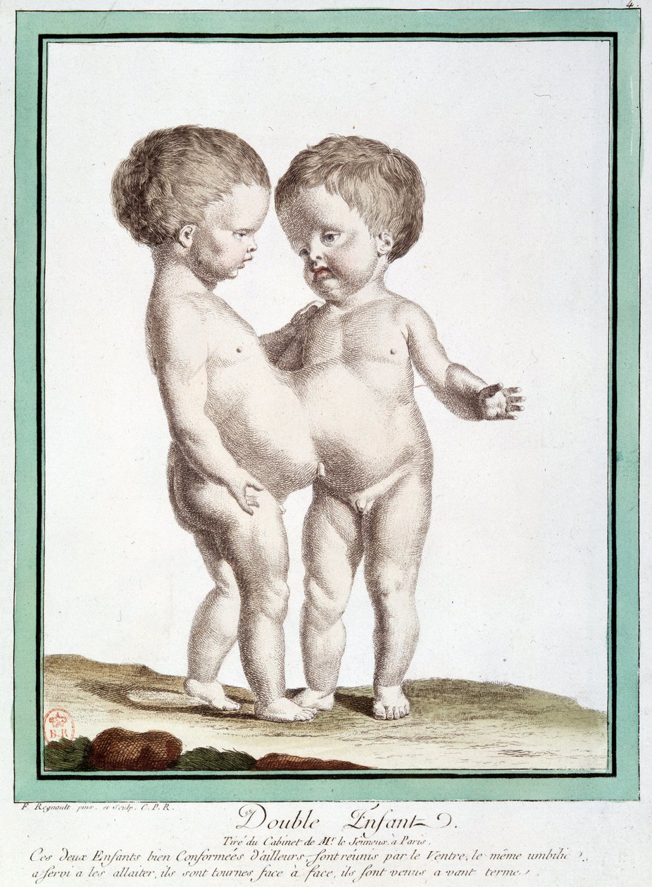 Dzieci syjamskie - w „Odchyleniach natury” autorstwa Régnault autorstwa Jean Baptiste Regnault