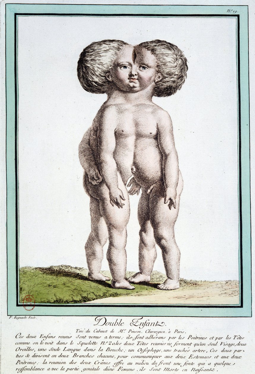 Dzieci syjamskie - w „Odchyleniach natury” autorstwa Régnault autorstwa Jean Baptiste Regnault