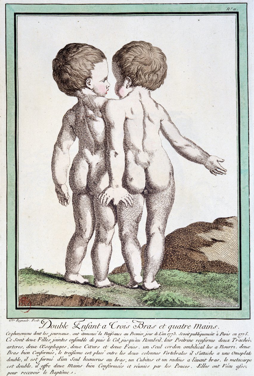 Dzieci syjamskie - w „Odchyleniach natury” autorstwa Régnault autorstwa Jean Baptiste Regnault