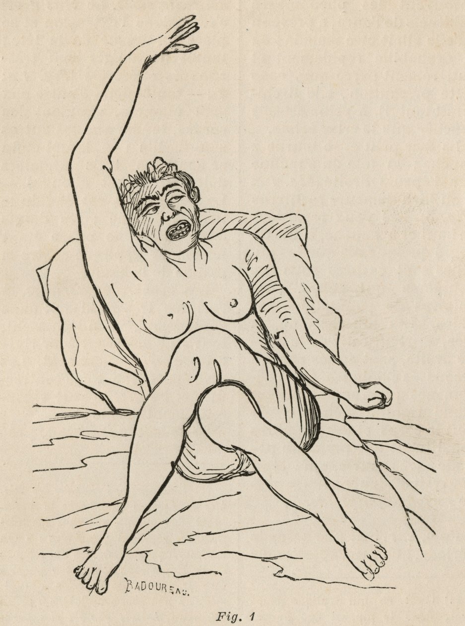 Epilepsja histeryczna, atak, skurcze, rys. 1 z "Iconographie Photographique de La Salpetriere" Bourneville et P. Regnard, Paryż, 1876 autorstwa Jean Francois Badoureau