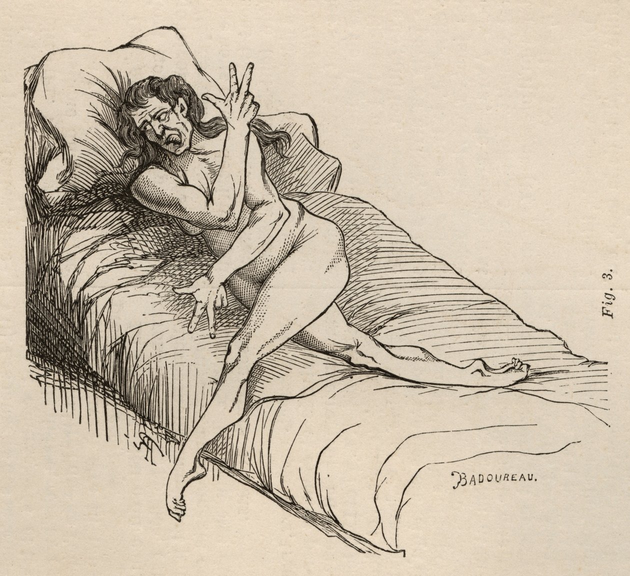 Epilepsja histeryczna, atak, wygięcia, ryc. 3 z „Iconographie Photographique de La Salpetriere” Bourneville et P. Regnard, Paryż, 1876 autorstwa Jean Francois Badoureau