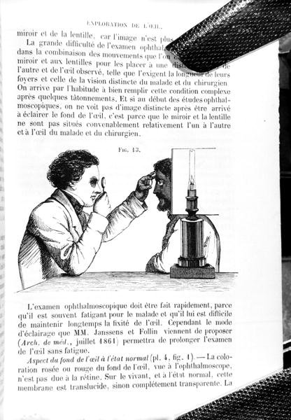 Ilustracja z „Traite Pratique des Maladies des Yeux”, tłumaczenia „Podręcznika zasad i praktyki medycyny i chirurgii okulistycznej”, Thomasa Whartona Jonesa (1808–91), autorstwa E. Fouchera, opublikowanego w Paryżu 1862 (rycina) (b /w zdjęcie) autorstwa Jean Francois Badoureau