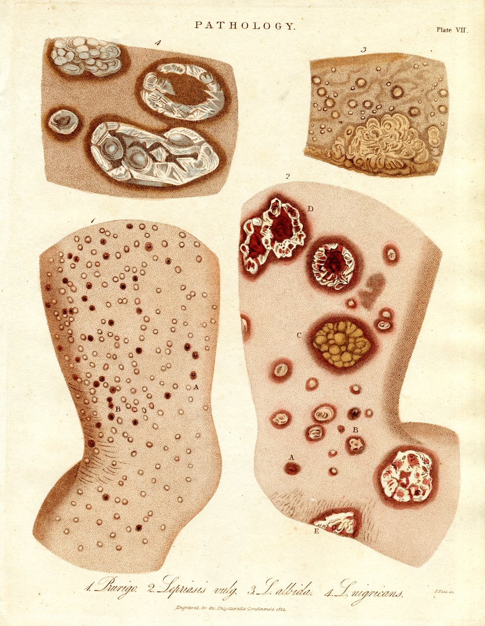Patologiczne choroby skóry: Schurigie;Leprous Skin;Pallada i Impetigo autorstwa John Pass