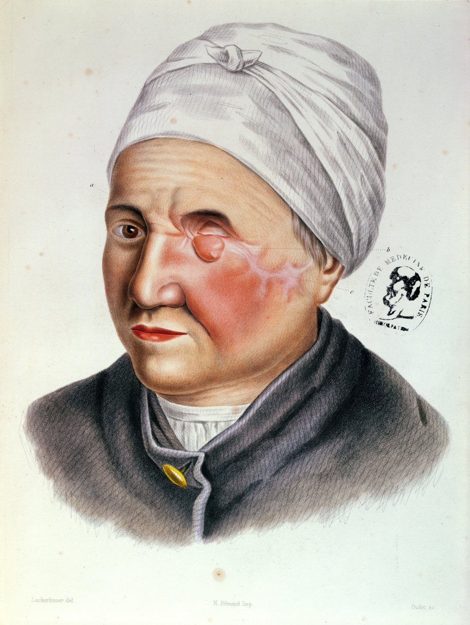 Ilustracja z Traite de Chirurgie Plastique autorstwa Antoine